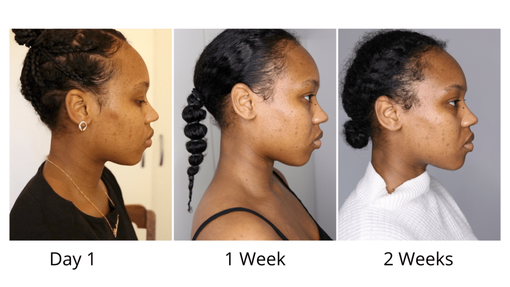 قبل و بعد از استفاده سرم پیلینگ اوردینری