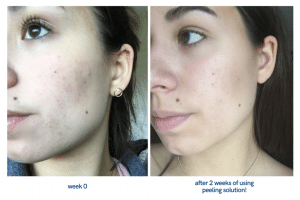 تاثیر سرم پیلینگ اوردینری