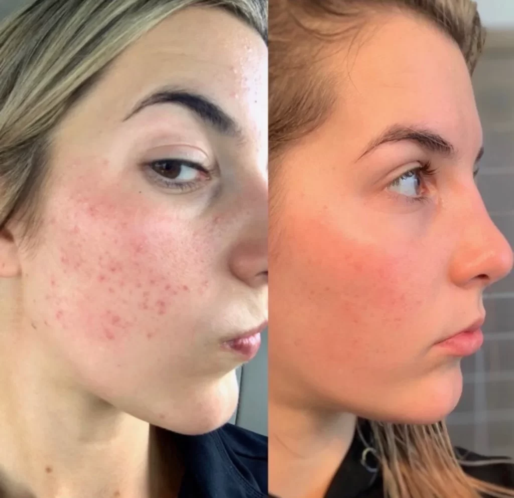 تاثیر سرم اوردینری لاکتیک اسید بر روی جوش