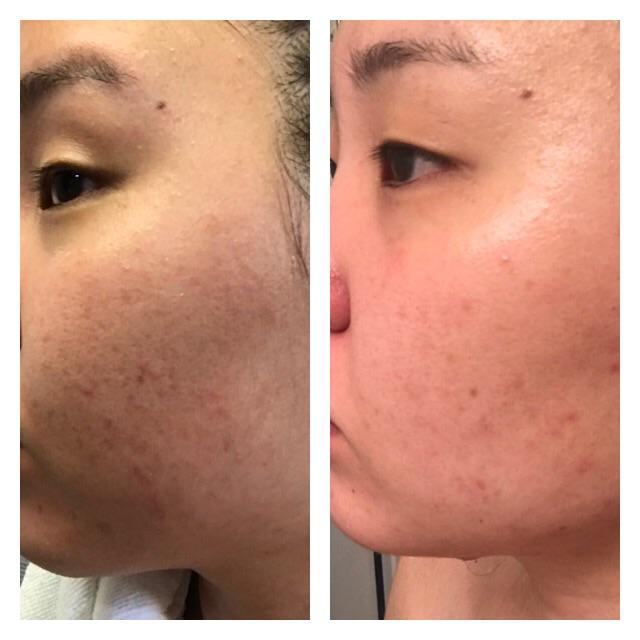 قبل و بعد استفاده از کرم سیکالفیت اون