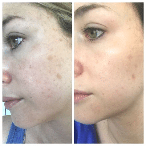 تاثیر سرم لاکتیک اسید اوردینری