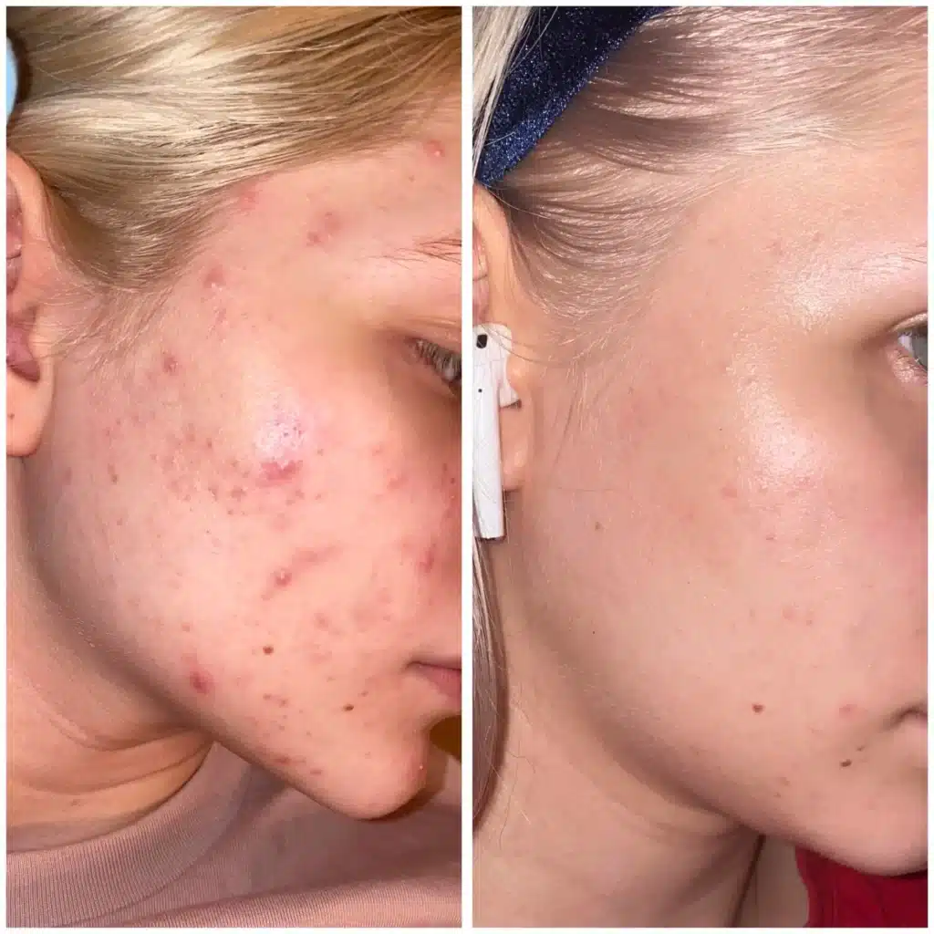 تاثیر سرم لاکتیک اسید اوردینری