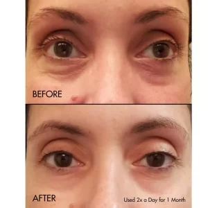 کرم دور چشم کلینیک