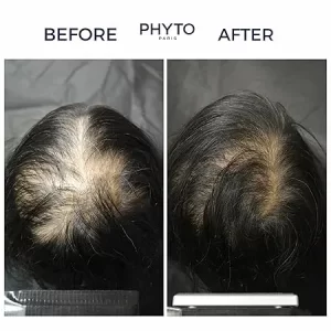 سرم ضد ریزش مو زنانه فیتو